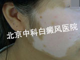 白癜风的危害性